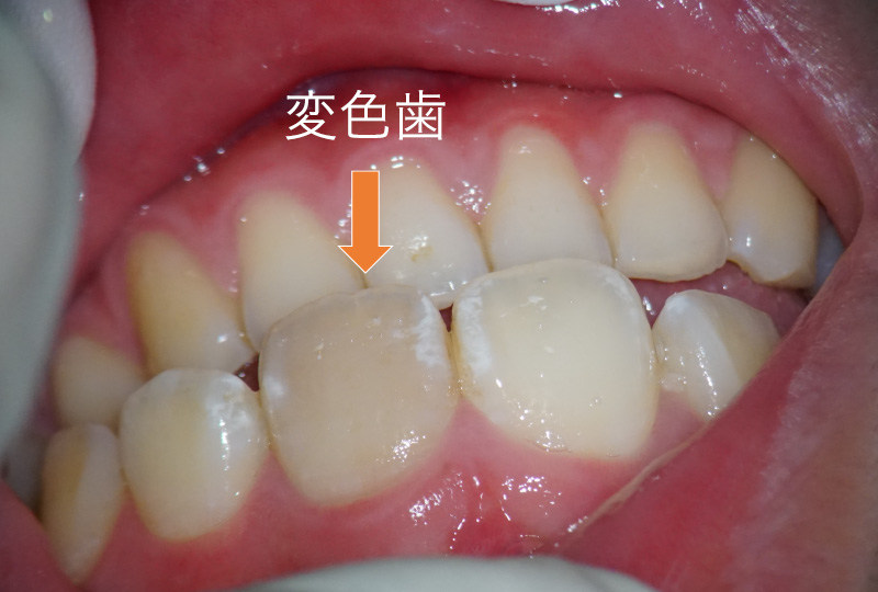 前歯の漂白事例